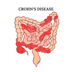 Higher ultra-processed food (UPF) intake is associated with an increased risk of incident Crohn’s disease (CD)